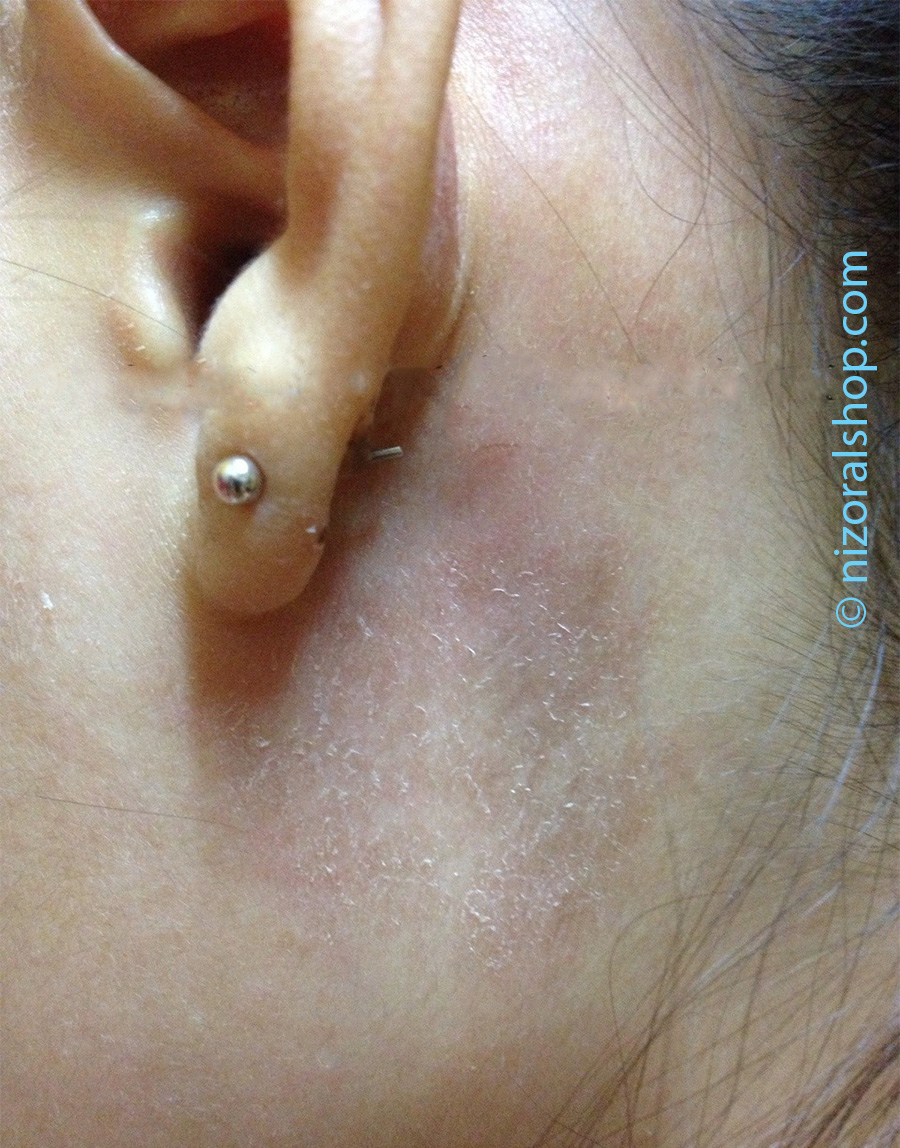 Natural Way To Rid Ear Infection Natural Way To Rid Ear Infection